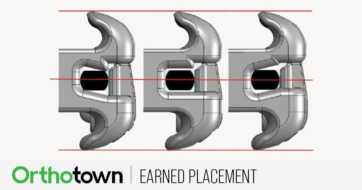 Earned Placement: Clinical Efficiency With ‘True Straight Wire’
