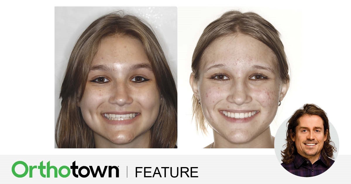 ‘Short-Face’ Patients—Part 4