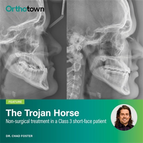 The Trojan Horse Dr. Chad Foster presents a nonsurgical Class III short-face case, showing how vertical changes improved both facial balance and occlusion.