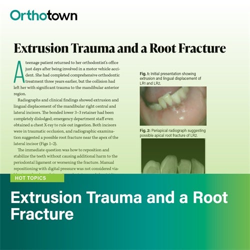Straight Talk: Extrusion Trauma and a Root Fracture Townies discuss managing a teenage patient’s dental trauma after a car accident, using light orthodontic mechanics and splinting to reposition extruded incisors, with emphasis on endodontic care and long-term follow-up.